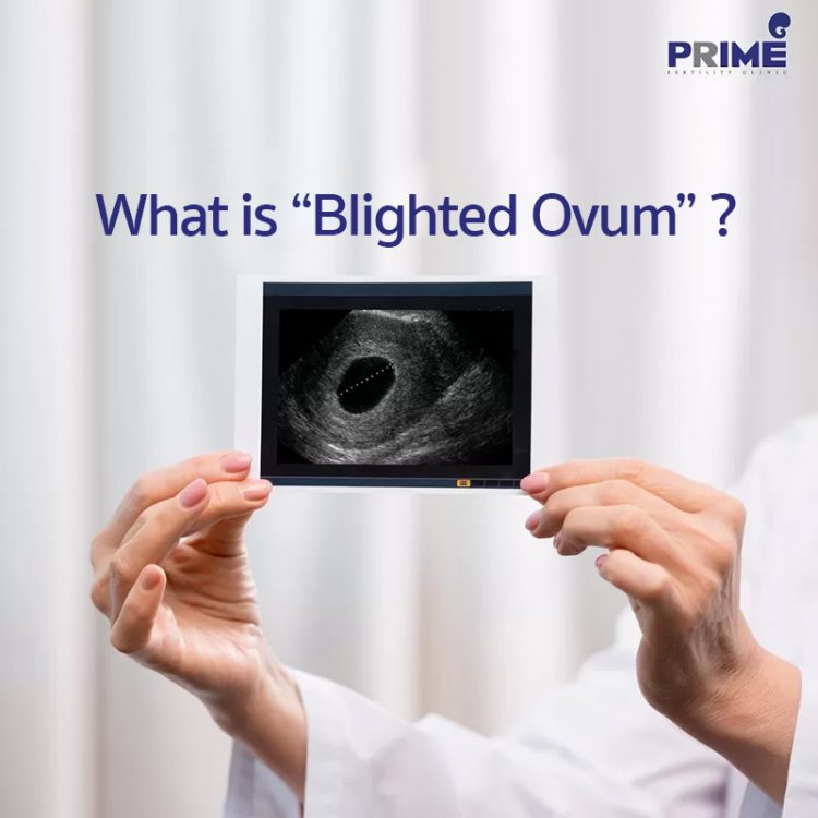 what-is-blighted-ovum-infertility-treatment-prime-fertility-clinic