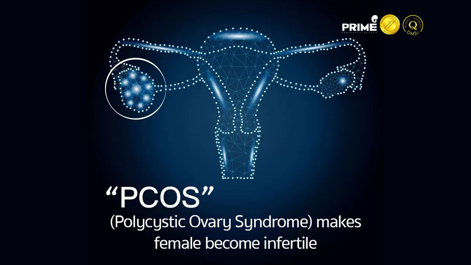 Pcos Polycystic Ovary Syndrome Makes Female Become Infertile Icsi