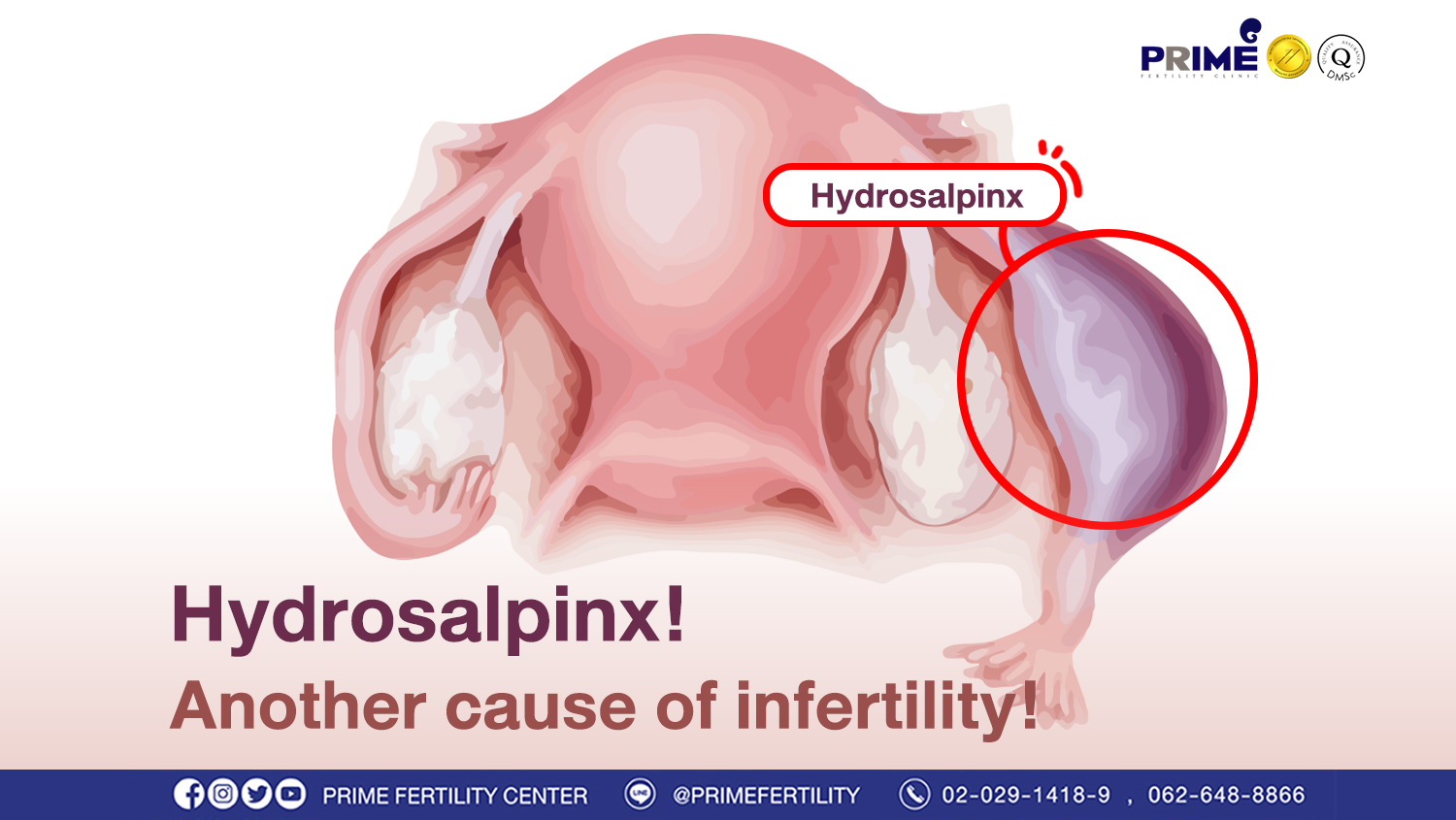 Hydrosalpinx! Another cause of infertility!