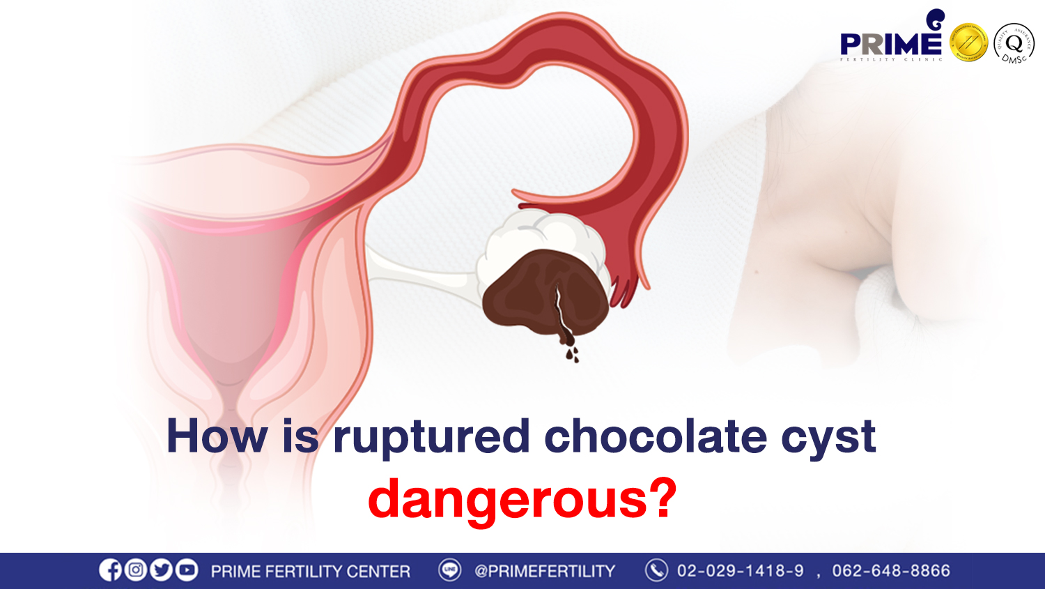 How is ruptured chocolate cyst dangerous?