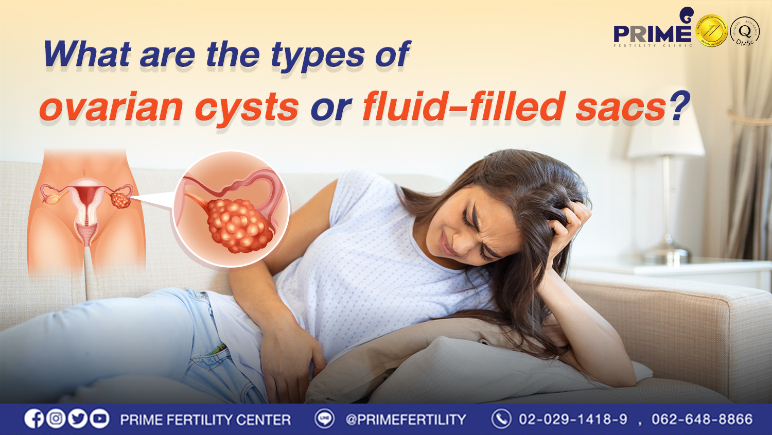 What are the types of ovarian cysts or fluid-filled sacs?